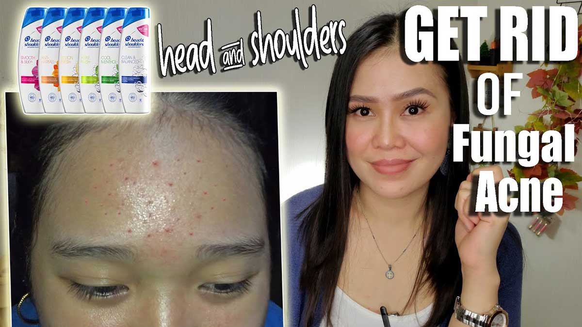 Head & Shoulders shampoo treat fungal acne